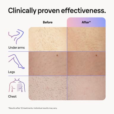 Braun Smart IPL Skin iExpert Pro 7 ljusbaserad hårborttagare PL7249